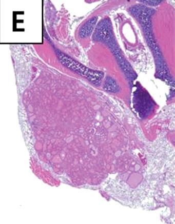 (F) Both lobes of thyroid gland have grown outside carotid arteries which are ascended