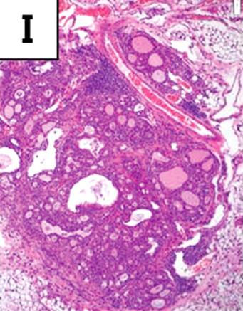 (I, J) Carotid artery is enclosed with thyroid gland.