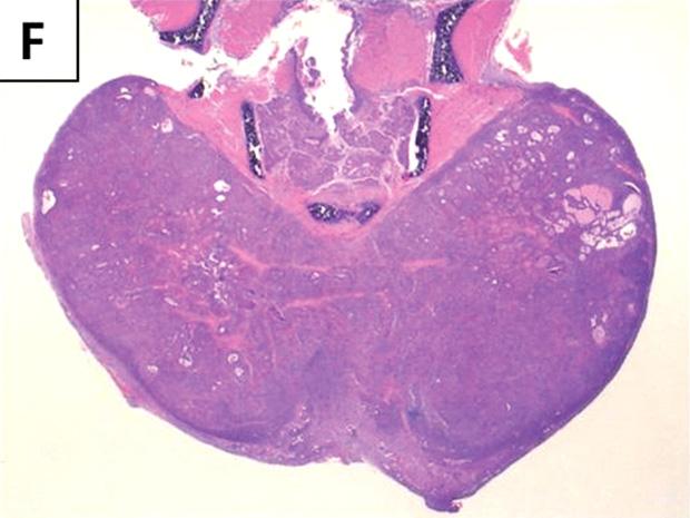 (J) Follicular cells with cilia-like structures are noted. 포로구성되며유두상이나고형성분이차지하는비율이좀더많아졌다 (Fig. 4C, D).