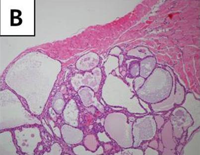 Follicles are variable in size and irregular in shape.