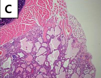 (B, C) Tumor growths are evident in surrounding skeletal muslce.