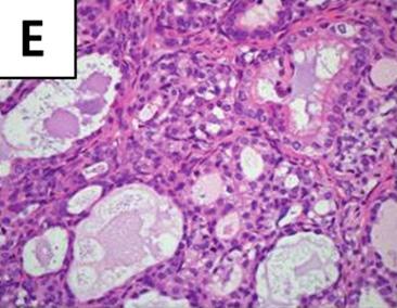 (G) There is a thyroid tumor follicle in submucosa of trachea.