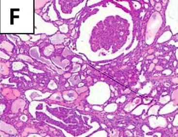 Metastatic lesion is a bulging out mass, measuring 2.5x2.5 mm.