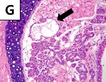 formed papillary structure.