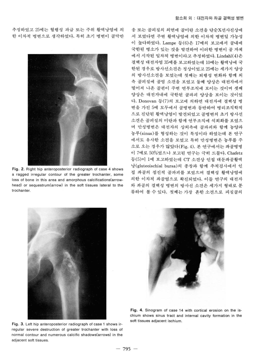 함소희외 대전자와좌콜결핵성병변 추정하였고 25