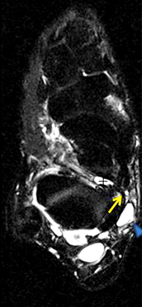 (C) Sagittal T2 (TR=4000/79 ms) image show medial planar nerve intraneural ganglion (arrowhead) and articular branch to subtalar joint (arrow).