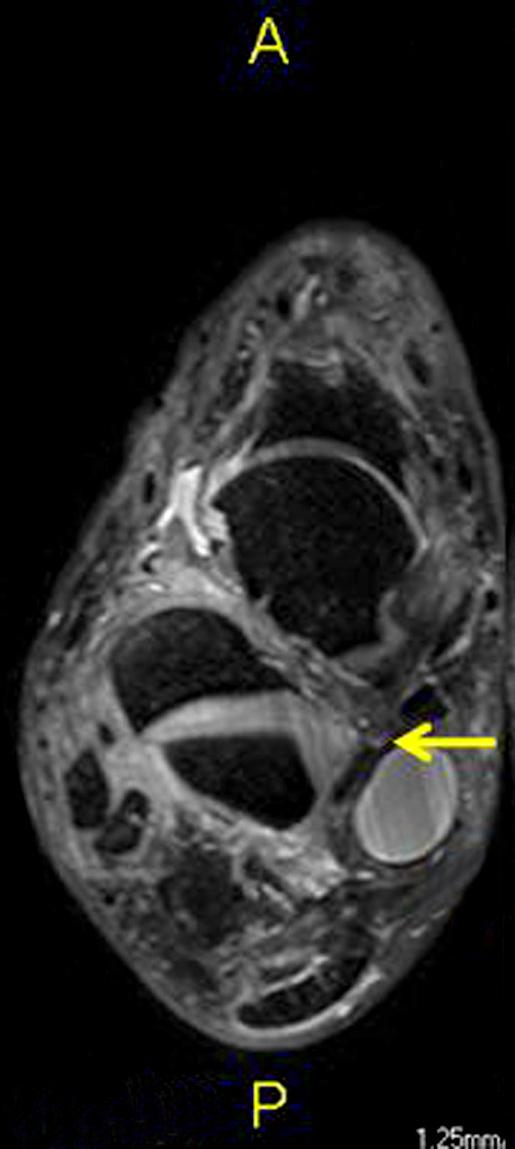 joint (arrow). That is from the lateral/median plantar bifurcation site to tarsal sinus root.