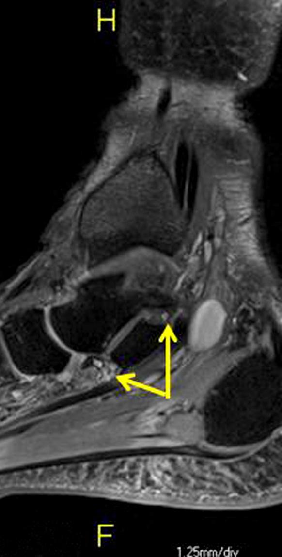 subtalar joint (arrow). (C) Axial image show articular branch to subtalar joint (arrow).