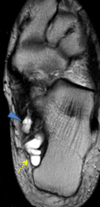 (B) Axial T2 (TR=4000/120 ms) image show medial plantar nerve intraneural ganglion (arrowhead) and