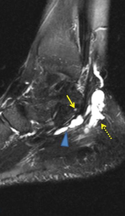 (C) Sagittal T2 (TR=4000/120 ms) image show medial (arrowhead) & lateral (dot arrow) plantar nerve