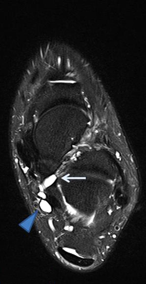 (A) Axial T2 (TR=8640/101 ms) image show lateral plantar nerve intraneural ganglion (arrowhead) and articular branch