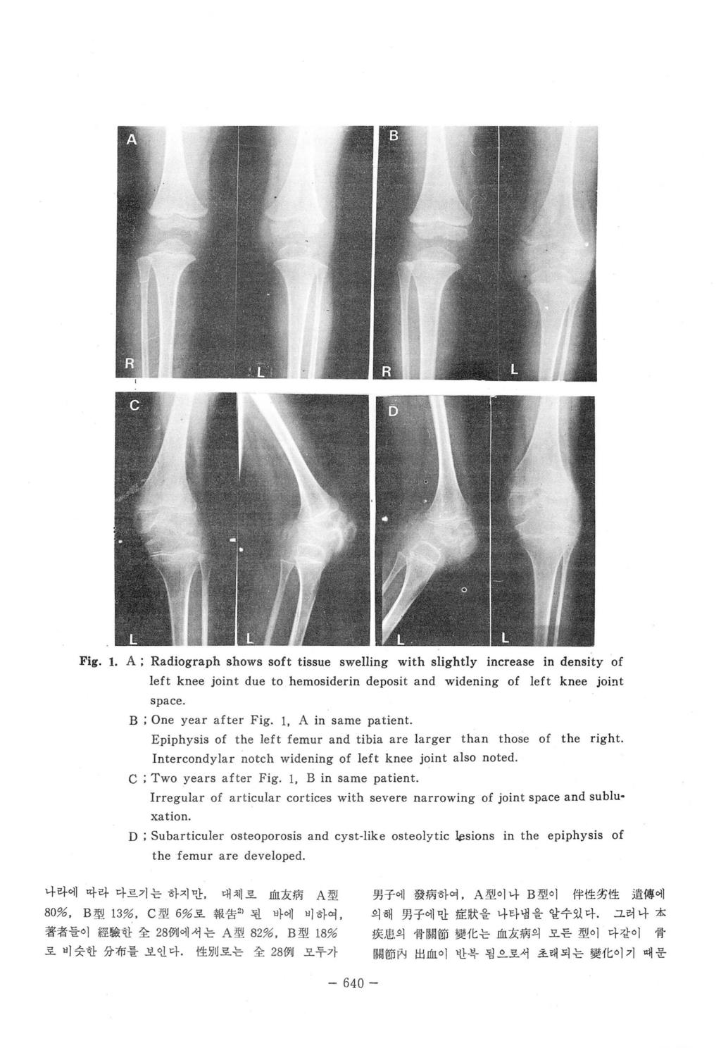 Fig. 1. A; Radiograph shows soft tissue swelling with slightly increase in density of Ieft knee joint due to hemosiderin deposit and widening of left knee joint space. B ; One year after Fig. 1. A in same patient.