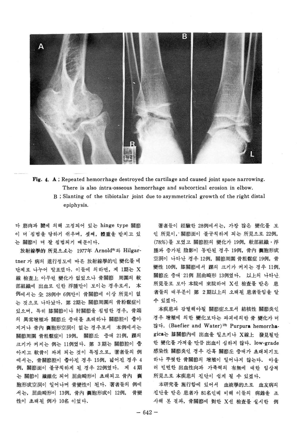 Fig. 4. A; Repeated hernorrhage destroyed the cartilage and caused joint space narrowing. There is also intra-osseous hernorrhage and subcortical erosion in elbow.