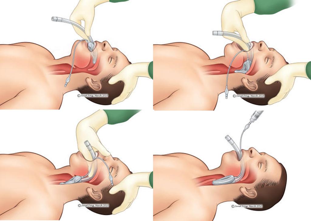 (3) 전문기도유지술 (advanced airway management technique) 손이나기도유지기로기도를유지하기어렵거나계속되는저산소증시에기도를확보하기위하여후두마스크 (laryngeal mask airway, LMA) 나기관내삽관을시행할수있다.