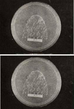 Fig. 19-21 : Sabouraud s dextrose agar plates in denture wearers showing confluent growth(denture group). Ⅳ.