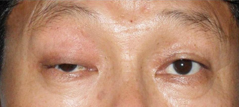- 대한안과학회지 2012 년제 53 권제 7 호 - A B Figure 1. The patient showed a ptosis in the right eye (A). A ptosis was improved after treatment with Pyridostigmine (B). 사는음성이었으나 (Fig.