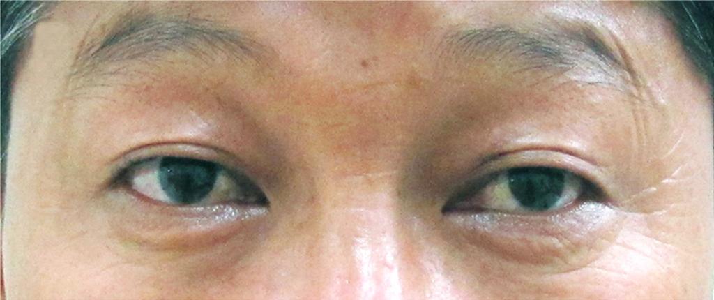 3일간의고용량부신피질호르몬주사요법이끝나환자는퇴원하게되었으나, Pyridostigmine 60 mg을처방하여환자에게약복용후눈꺼풀처짐증상의호전이있는지관찰하게하였다. 2일뒤외래로다시내원하였을때환자의눈꺼풀처짐증상이완전히호전되었으며, 갑상샘눈병증과동시에눈중증근무력증이동반되어있는것으로진단되었다 (Fig. 1). Figure 2.