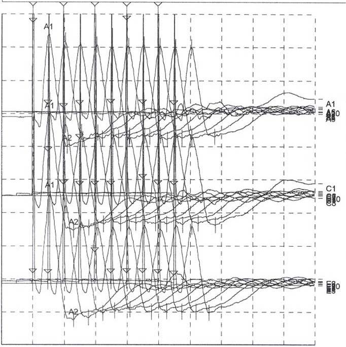 - Jun-Ho Choi, et al : Ocular myasthenia gravis, Graves disease - Table 1. Jolly test (orbicularis oculi muscle) Stimulation site Decrement (%) M1 amplitude (uv) M5 amplitude (uv) Rt.