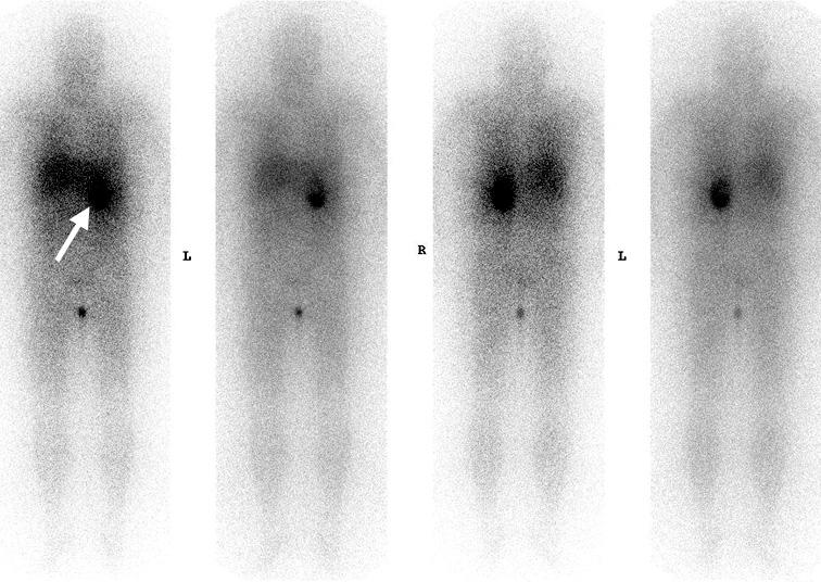 핵의학소견 : Iodine-131 metaiodobenzylguanidine (MIBG) scintigraph 에서좌측부신의 6.5 cm 크기의영역에섭취율이증가하여갈색세포종에합당한소견을보였다 (Figure 4).