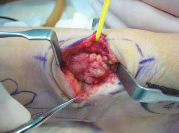 Min Wook Kim, et al. Recurrent Huge Benign Tumors in the Hands 좌측액와부위마취후에요골동맥과신경주위를둘러싸고있는형태의종양 (Fig.