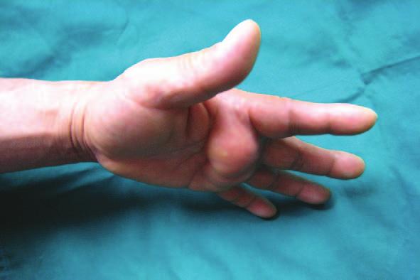 증례 2 55세남자환자로 4-5년전부터발견된좌측손바닥의종물이 1개월전부터는손등으로까지확대되는주소로내원하였다 (Fig. 5). 이학적검사와함께자기공명영상검사가시행되어졌다.