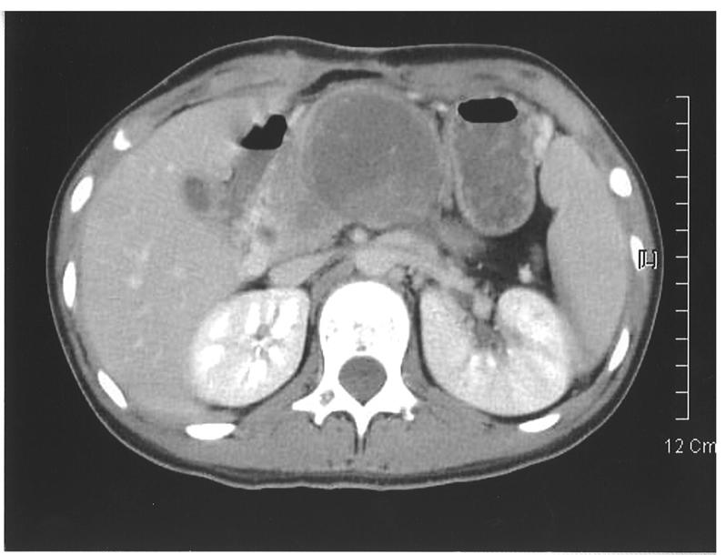 34 소아외과제 12 권제 1 호 2006 년 Fig. 3. Follow-up abdominal CT scan after 3 cycles of chemotherapy. The pancreatic mass decreased in size. Fig. 4.