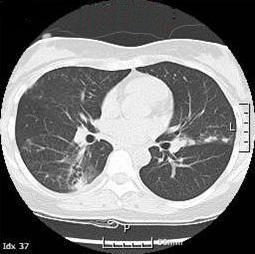 Tbc with a transbronchial disseminated status. Mild bronchiectasis was noted in the right upper lobes. Enlargement of the mediastinal lymph nodes was not noted.