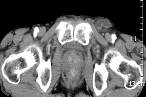 Ho-gil Yoo, et al:the Diagnostic Concordance of Femoral Hernia and the Factors Influencing Diagnosis 183 Fig. 3.