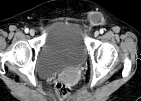 There are no typical findings of femoral hernia which are venous compression and localized sac in femoral ring on CT image (arrows).