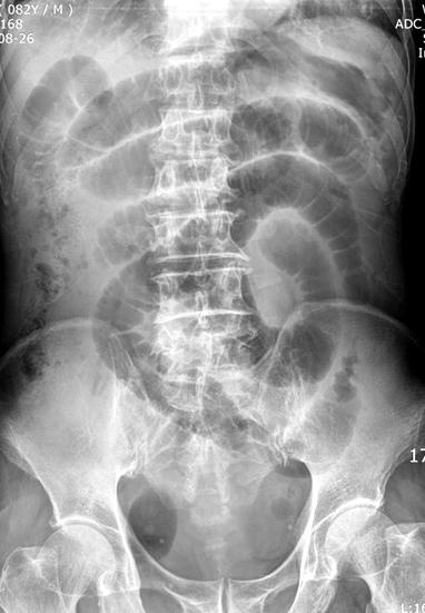 Ho-gil Yoo, et al:the Diagnostic Concordance of Femoral Hernia and the Factors Influencing Diagnosis 185 Fig. 4. Emergency operation was done due to severe bowel obstruction of right femoral hernia.