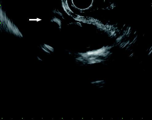 괴사를동반한급성중증췌장염에서경피적내시경적괴사제거술의성공적인치험 1 예 41 Fig. 2. Endoscopic ultrasound (EUS) view. Multiple GB stones and sludges with cholecystitis were detected. 의증가가관찰되어 (Fig.