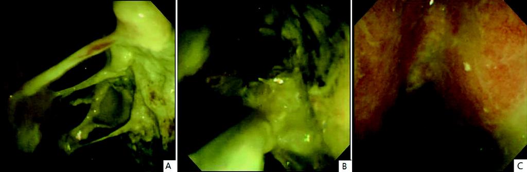 권문혁외 7 명 42 Fig. 4. Endoscopic view. (A, B) Endoscopy showed removal of necrotic debris by net-snare. (c) Endoscopy showed clean cavity after completion of percutaneous endoscopic necrosectomy. 다.