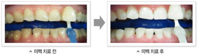 치아를하얗게하고싶어요 치아미백 전문가미백 구강검진 + 스케일링 + 레이저미백치료 3 회 자가미백