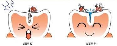 적정량의불소는충치예방에탁월한효과 실란트 -