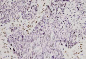 난소상피암에서현미부수체불안정성 383 A B Fig. 3. Immunohistochemical staining for hmlh1 and hmsh2 in serous carcinoma showing MSI-H.