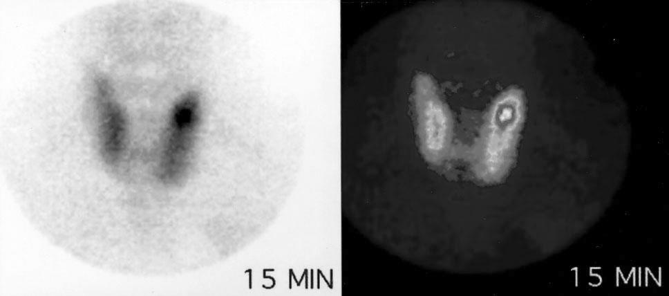 5 cm heterogenous low echogenic mass in the upper pole of the left thyroid lobe. meq/l, 총단백질 7.3 g/dl, 알부민 4.6 g/dl, 인 2.8 mg/dl (2.5~4.5), 요산 2.3 mg/dl으로정상범위에있었고, 칼슘은 12.3 mg/dl (8.5~10.