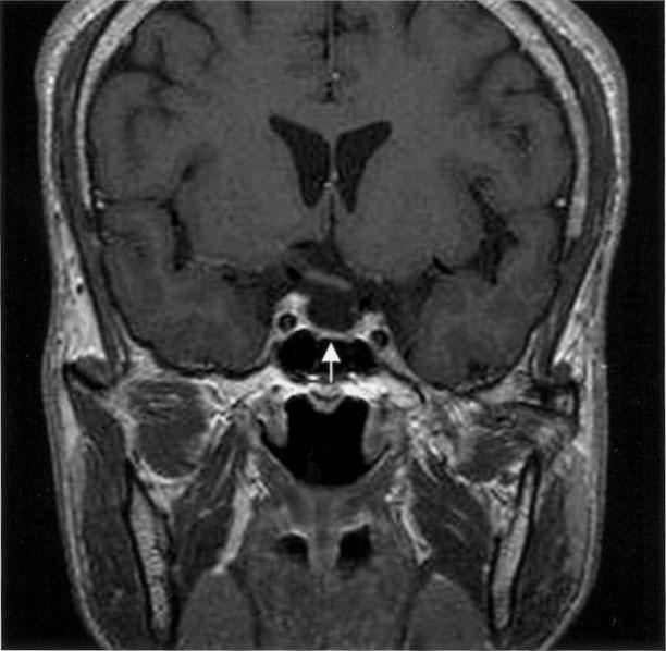 대한내분비학회지: 제 21 권 제 6 호 2006 (0~20), 메타네프린 0.6 mg/day (0~1), 유리 코르티솔 70.7 μ 유전자검사: 환자의 말초혈액에서 genomic DNA를 뽑아 g/day (20~90)로 모두 정상 범위에 있었다.