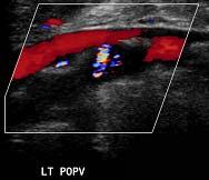 2017년 05월 30일 US color doppler low. ext. vein(fig. 2) (1) Venous insuffciency of Lt. popliteal vein (2) No evidence of thrombus in both lower extremity vein (3) Soft tissue sweeling in Lt.