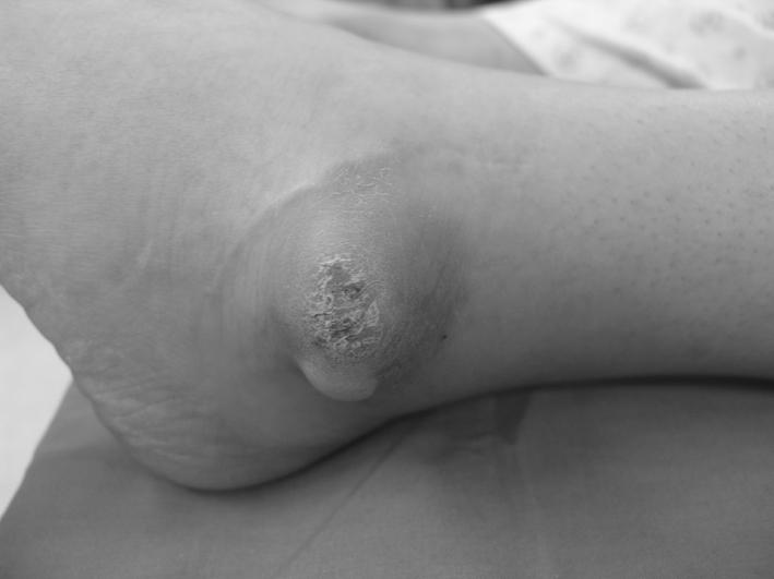 Figure 2. Thick callosity and pus collection was seen around the lateral malleolar area. Also previous operative scar was seen on anterior fibular margin.
