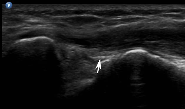 아래영상은팔꿈치관절내측면영상이다. 화살표가가리키는구조물은? 가. Ulnar collateral ligament 나.