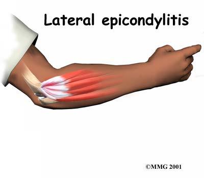 Lateral Epicondylitis Tennis elbow 팔꿈치의가장흔한문제 유병률 ; 1~3% 주된기전
