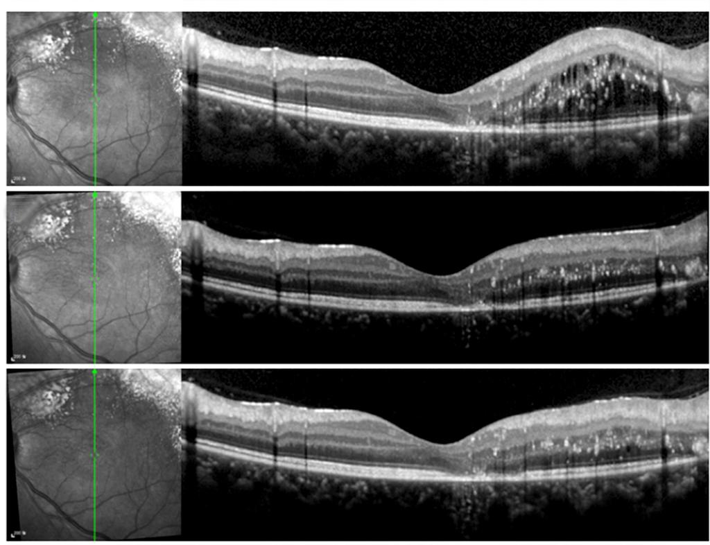 () No definite improvement was observed at a month after first intravitreal ranibizumab injection and photocoagulation. C Figure 2. Optical coherence tomographs of the left eye.