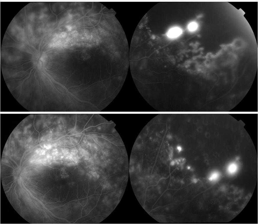 - 대한안과학회지 2017 년제 58 권제 7 호 - Figure 3. Fluorescein angiographs of the left eye.