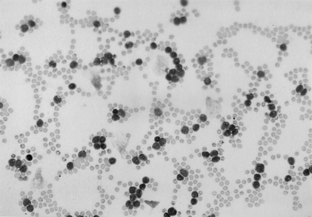 Ji Soo Kim, et al : A case of de novo B cell prolymphocytic leukemia associated with false positive direct antiglobulin test Fig ure 1.