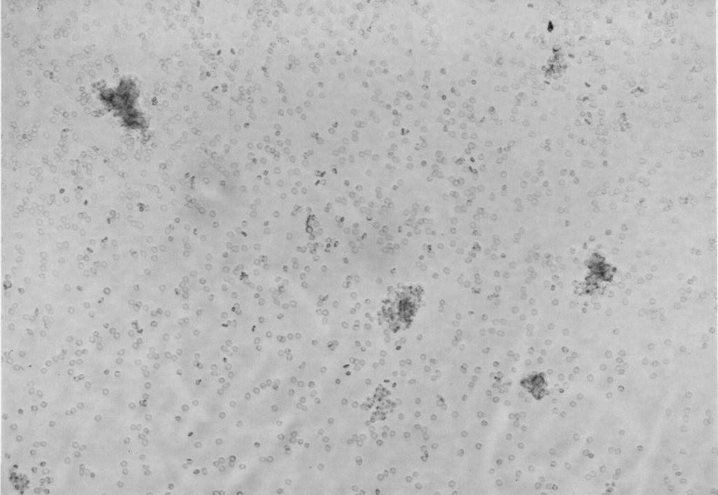 : 59 4 482 2000 Figure 4. Direct Coombs' test reveals several RBC agglutination like clumps which was erroneously read as positive.