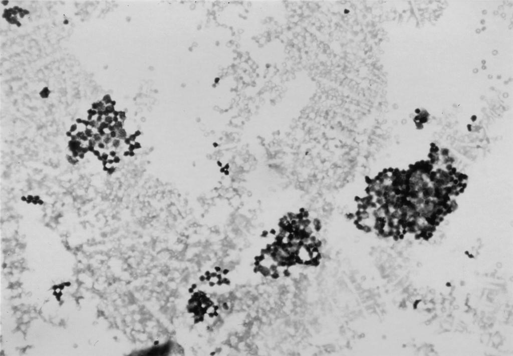 After Wright staining of dried direct Coombs' testing slide many well marked clumping of prolymphocytes are identified. (Wright stain, 200),, 3). 2:1, 70. 50.,.,,, 18), Table 1.