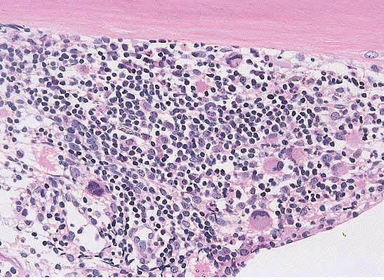 8%, 평균적혈구용적 (mean corpuscular volume, MV) 78.3 fl, 평균적혈구혈색소 (mean corpuscular hemoglobin, MH) 26.5 pg, 평균적혈구혈색소농도 (mean corpuscular hemoglobin concentration, MH) 33.8%, 망상적혈구 0.25% 이었다.