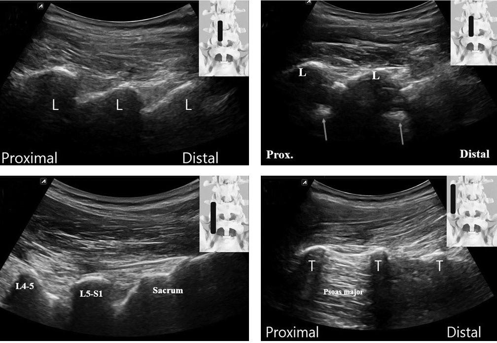 Journal of Korean Society of Spine Surgery Ultrasound-Guided Injections in the Lumbosacral Spine A B C D A Fig. 2. Longitudinal spinal sonographic view. (A) A sonogram showing the laminas.