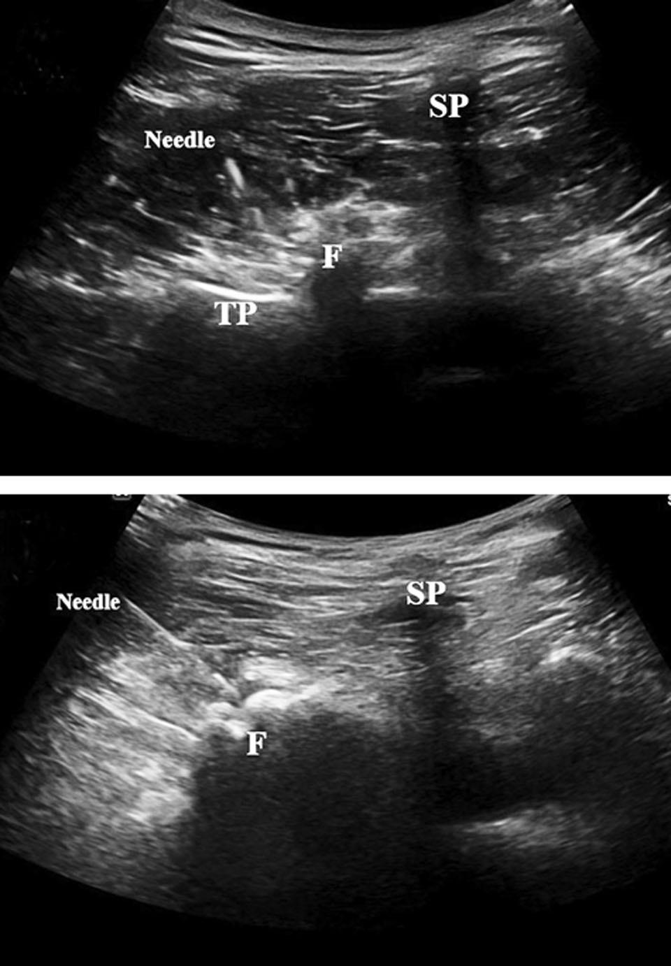 Journal of Korean Society of Spine Surgery Ultrasound-Guided Injections in the Lumbosacral Spine ramus) 의내측분지 (Medial branch) 는후방관절뿐만아니라, 다열근 (Multifidus), 극간근육 (Interspinous muscle) 과극간인대