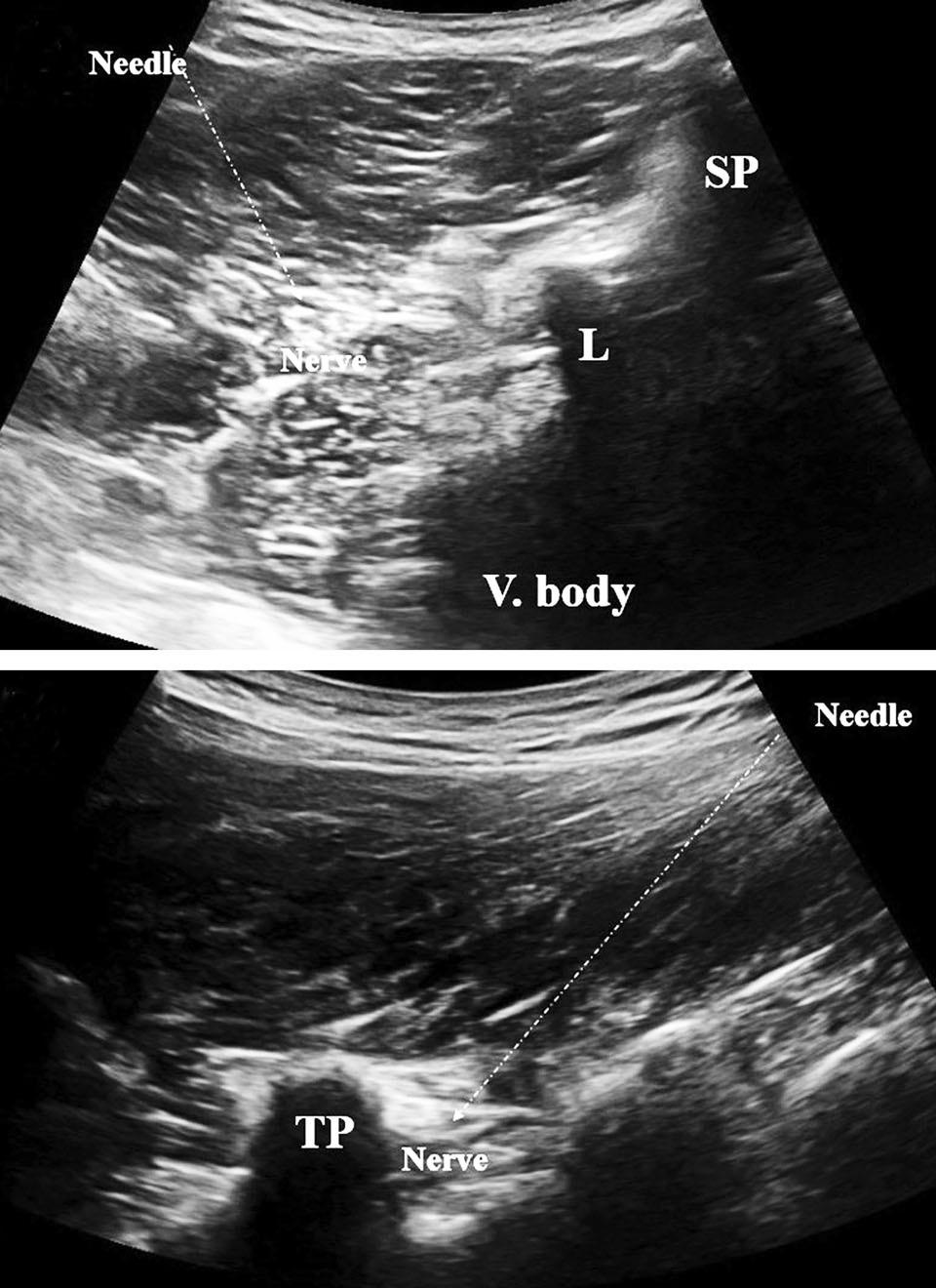 (Inter-transverse ligament) 의직하방심부부위에있는신경을향해서주사를놓는방법이다. 이때각각신경근에대하여 0.2 % Ropivacaine 2 ml를주사한다.